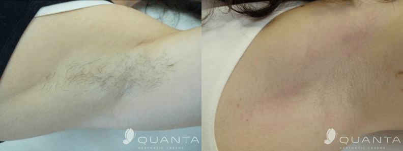 hair-removal-armpit-755-before_after