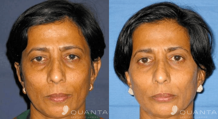 Wrinkles-Face-1-1064SP-Before_After