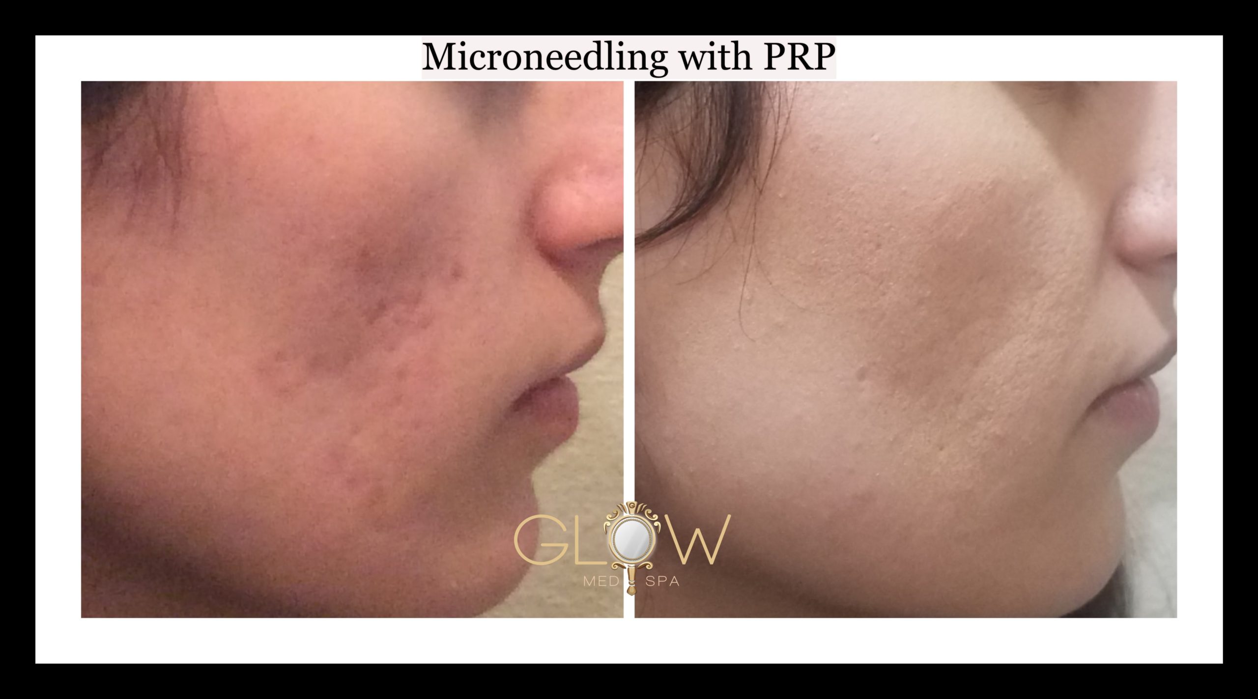 Microneedling with PRP, remove acne scarjpg