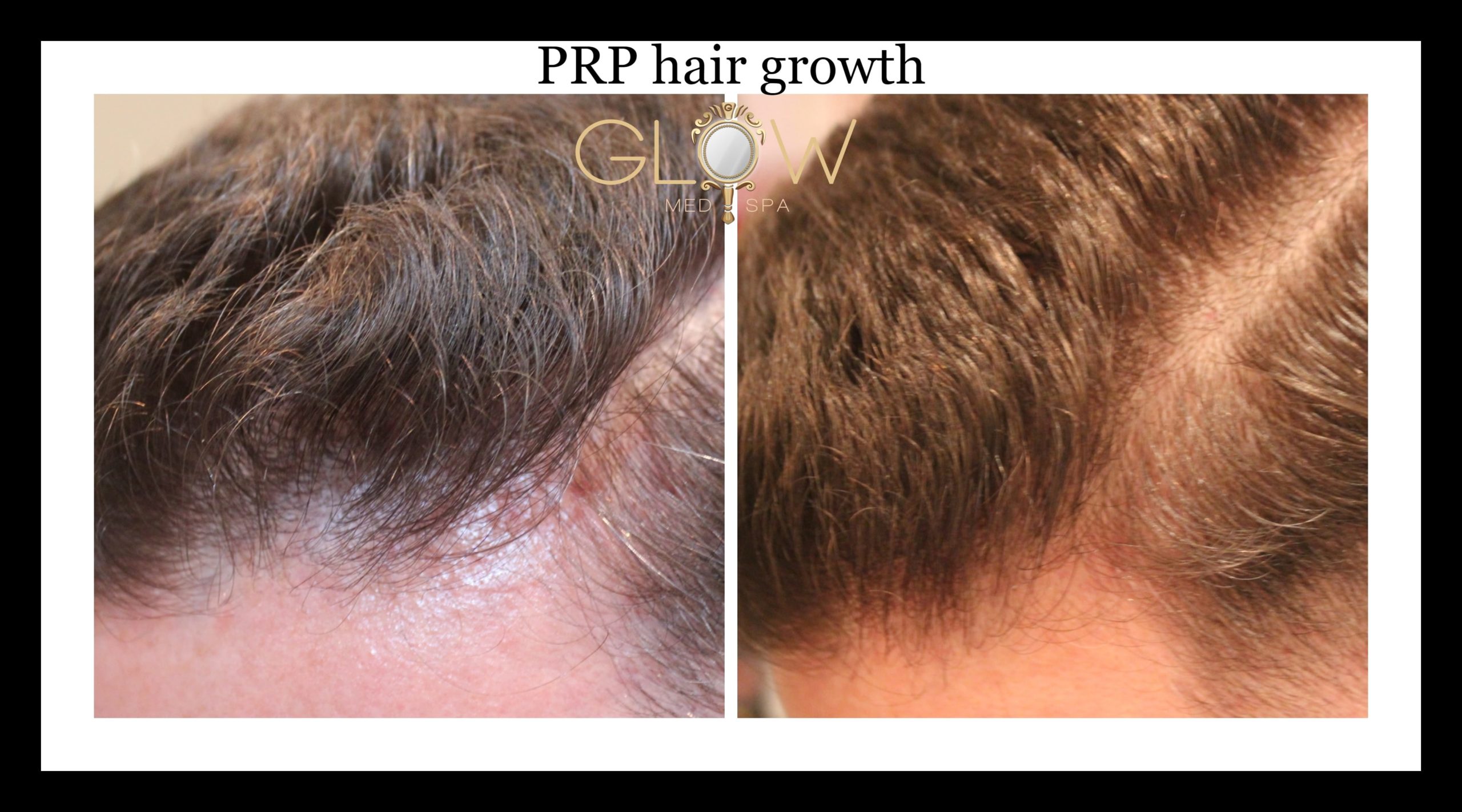 PRP hair growth glow med spa