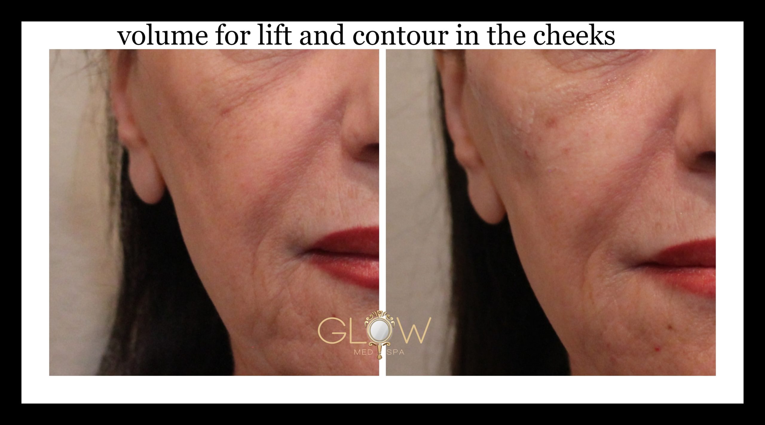 volume for lift and contour in the cheeks