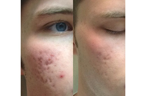microneedling acne scaring