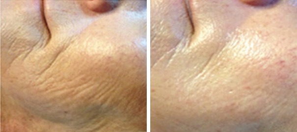 microneedling fine lines and wrinkles