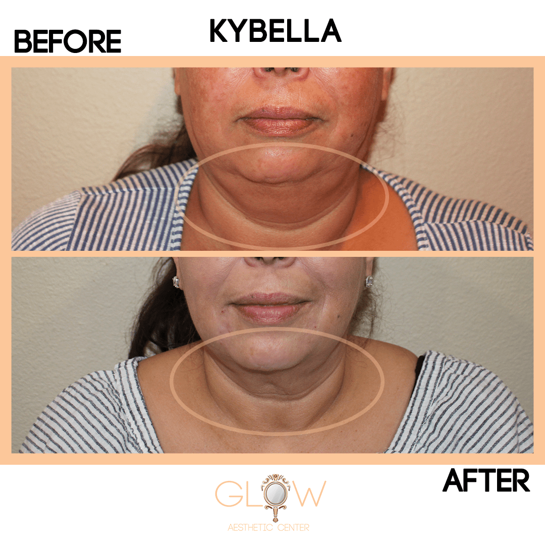 Kybella Before and After 03062020