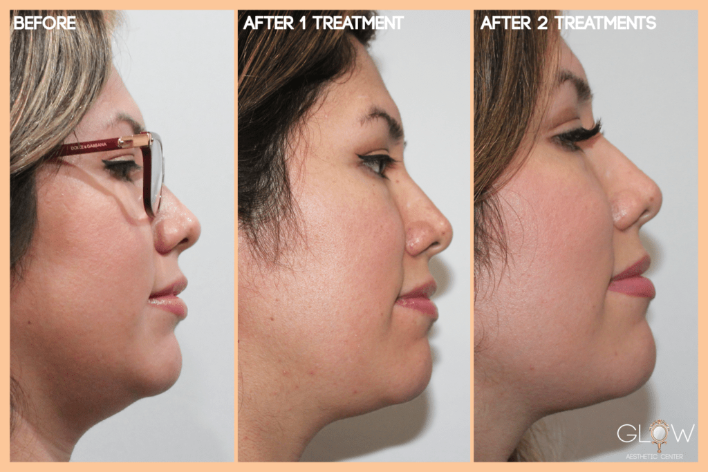Before and after photos showcasing the results of aesthetic treatments on a woman's profile, highlighting improvements in facial contours after one and two treatments at Glow Aesthetic Center.