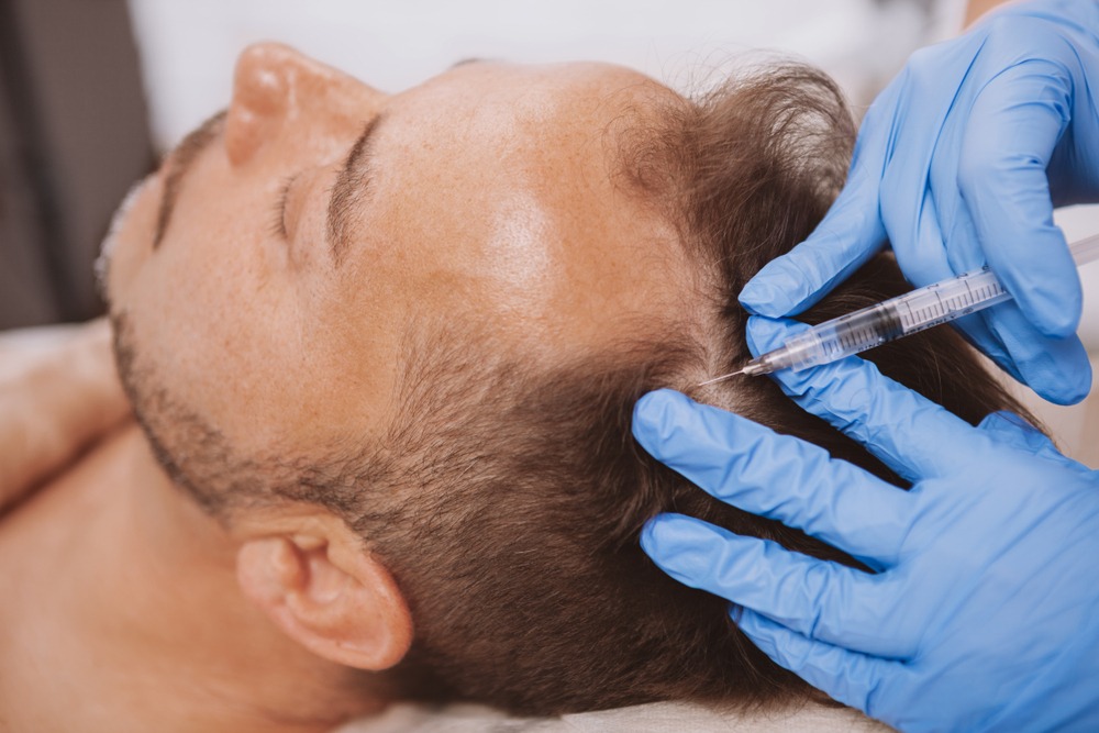 A healthcare professional administering a hair restoration treatment via injection on a male patient's scalp, highlighting the procedure for hair loss recovery.