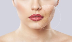 Does Microneedling Help With Scarring?