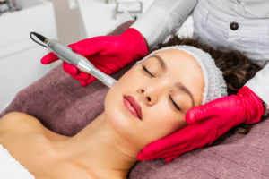 Does microneedling help with acne scars?