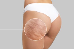 How to get rid of Cellulite?