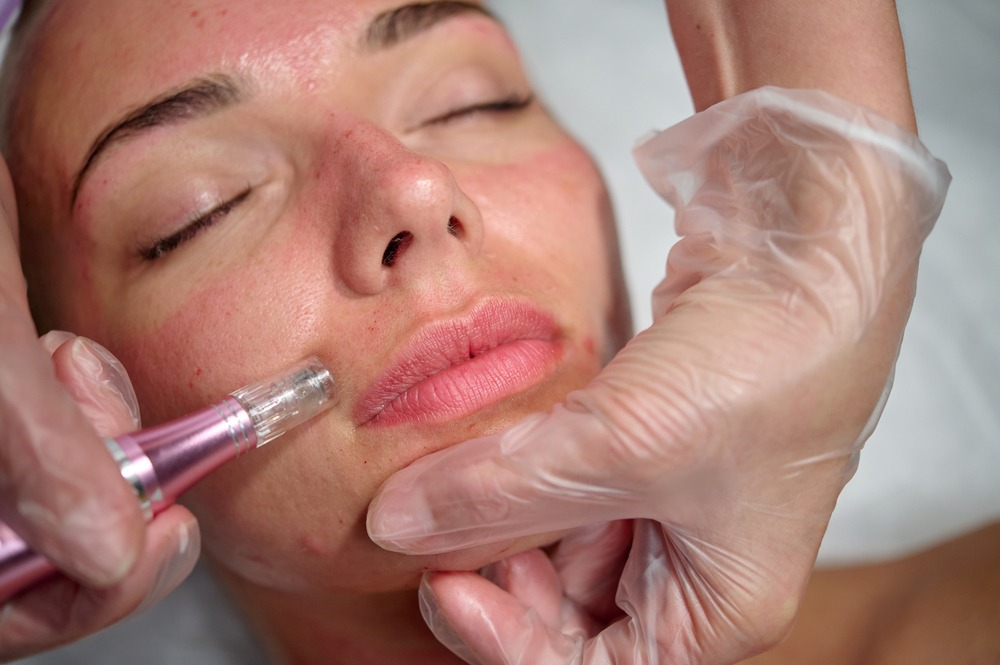 Microneedling treatment session in progress, featuring a close-up of a woman receiving facial rejuvenation. A technician uses a microneedling device on her skin while wearing gloves, highlighting the procedure's focus on skin texture improvement and acne scar reduction.