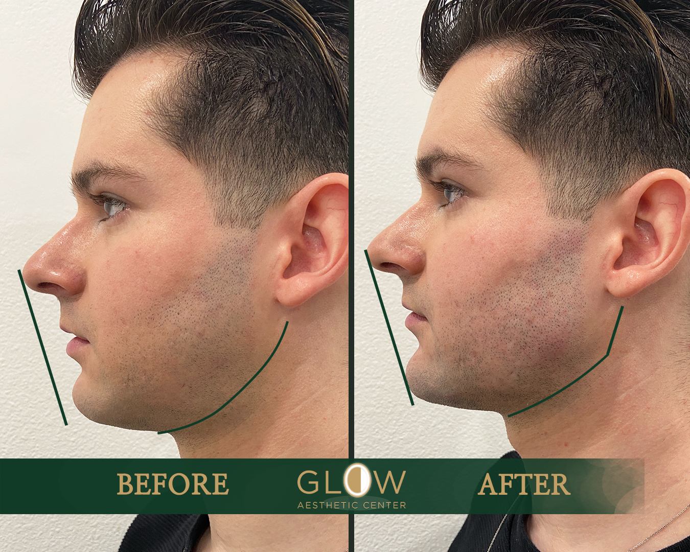 Before and after image showcasing a male patient’s facial profile transformation at Glow Aesthetic Center, highlighting improvements in jawline definition and overall facial symmetry.