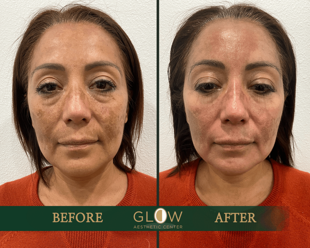 Before and after comparison of a facial aesthetic treatment at Glow Aesthetic Center, showcasing significant improvement in skin tone and texture. The left side displays visible skin imperfections, while the right side highlights a smoother, rejuvenated appearance.