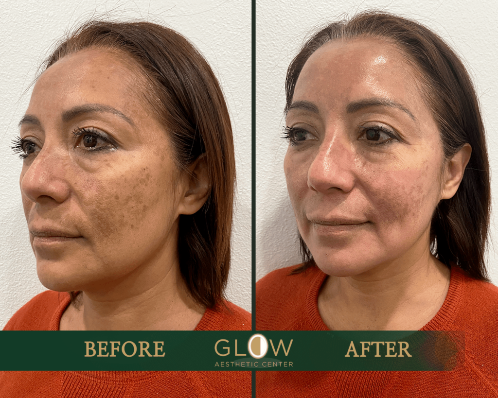 Before and after comparison of a woman's facial skin treatment at Glow Aesthetic Center, showcasing significant improvement in skin tone and texture, with reduced pigmentation and enhanced radiance.