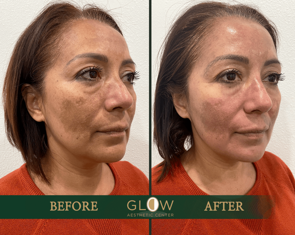 Before and after comparison of a facial treatment at Glow Aesthetic Center, showcasing significant improvement in skin tone and texture. The left side displays visible skin imperfections, while the right side highlights a smoother, more radiant complexion.