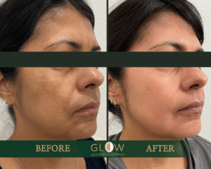Cosmelan Hyperpigmentation Treatment in Reseda, CA