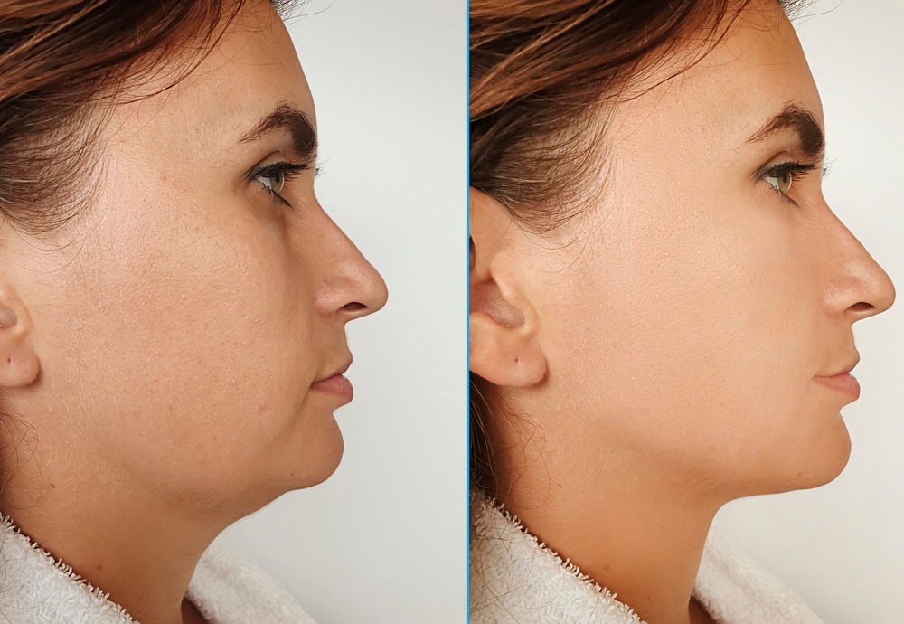 Kybella Treatment in Reseda CA Glow Aesthetic Center