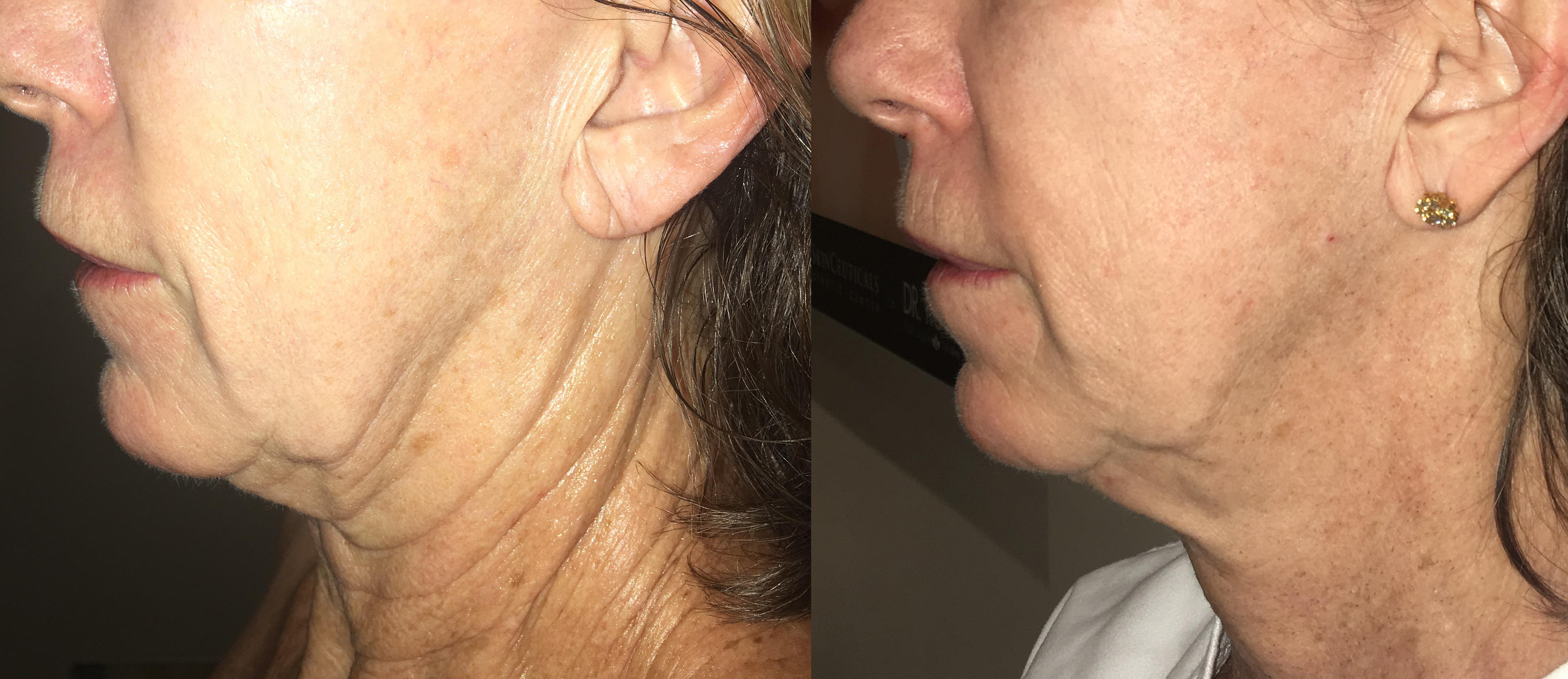 Morpheus8 Treatment in Encino CA 11