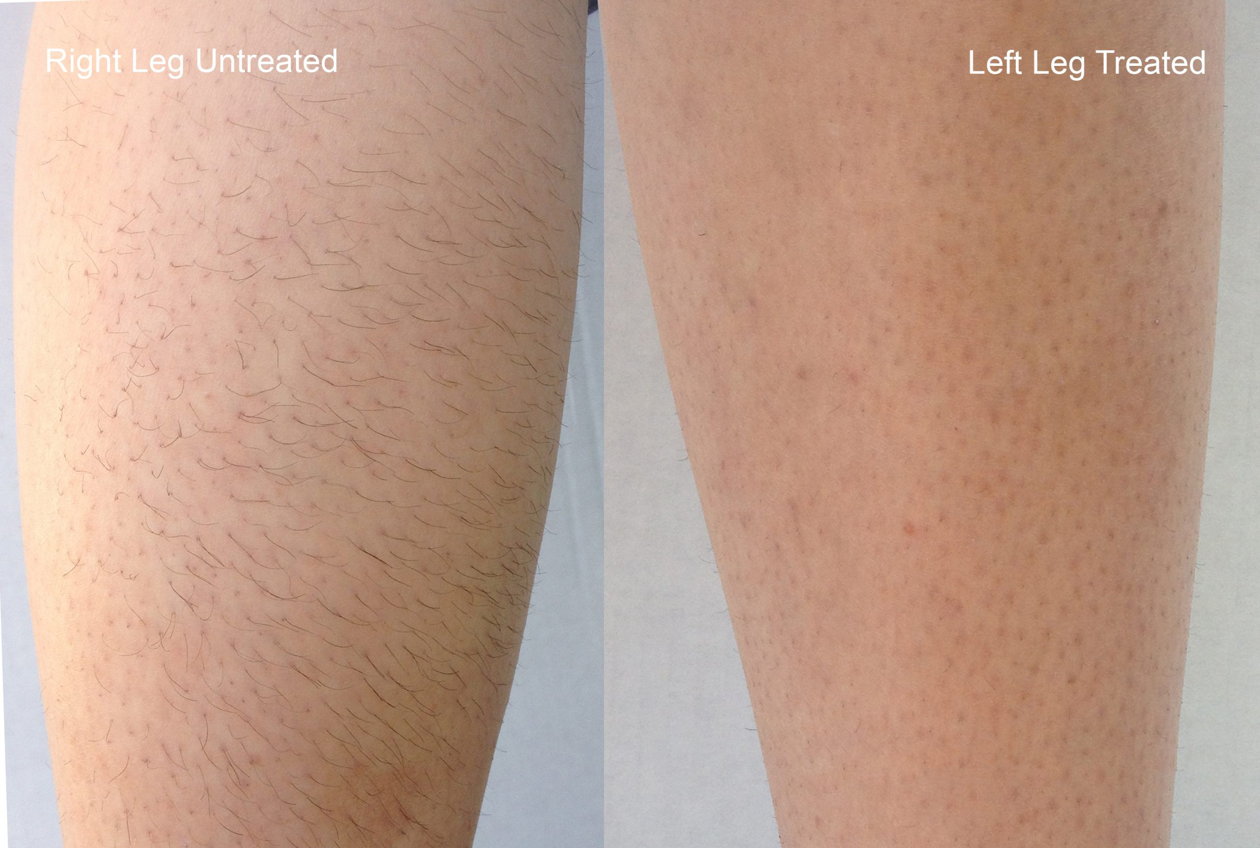 Comparison of untreated and treated legs showing hair removal results; the left leg is treated and appears smoother with less visible hair, while the right leg remains untreated with noticeable hair growth.