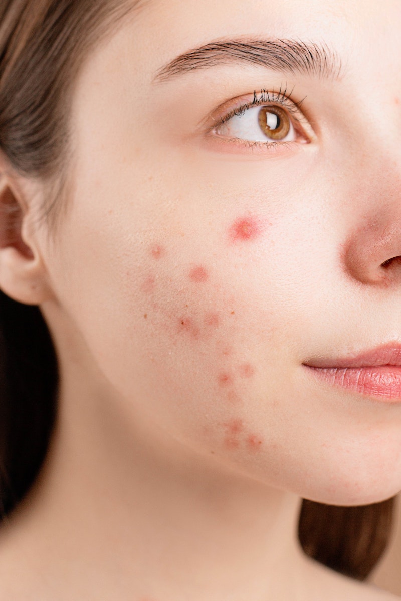Close-up image of a young woman with acne on her cheek, showcasing various types of blemishes and skin texture. The focus is on the skin's condition, highlighting the challenges of acne management and skin care.