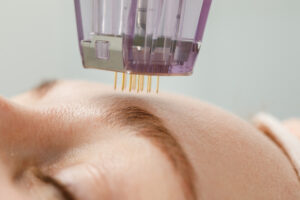 Microneedling 101: Why Aren’t You Doing It Too?