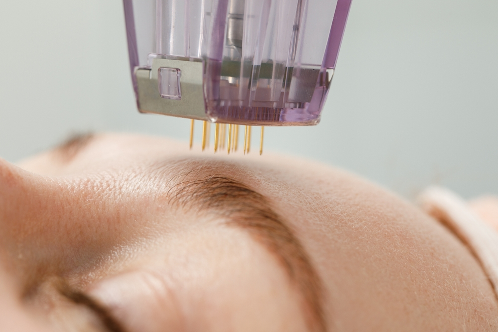 Microneedling treatment in progress on a client's forehead, showcasing the microneedling device with fine needles for skin rejuvenation and collagen stimulation.