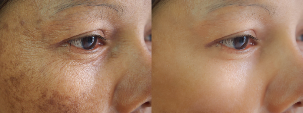 Close-up comparison of a woman's skin showing before and after treatment, highlighting visible signs of aging, including wrinkles and dark spots on the left, and smoother, clearer skin on the right.