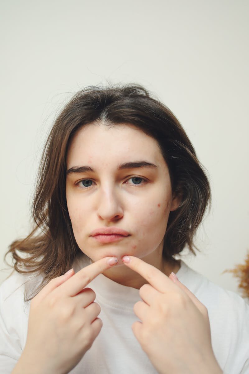 A young woman with acne examining a pimple on her cheek in a thoughtful expression.