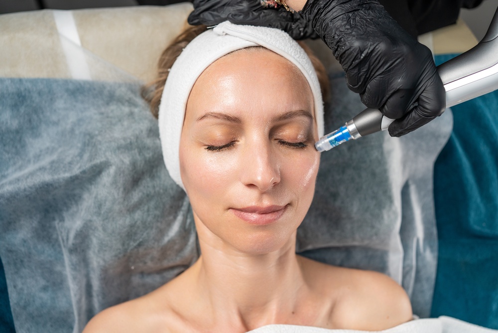 Why You Should Be Microneedling Under Eyes