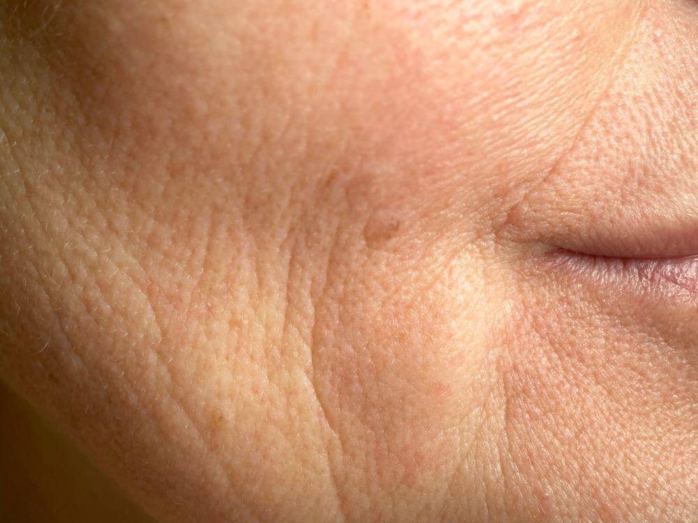 How Nasolabial Fold Filler Can Make You Look Younger